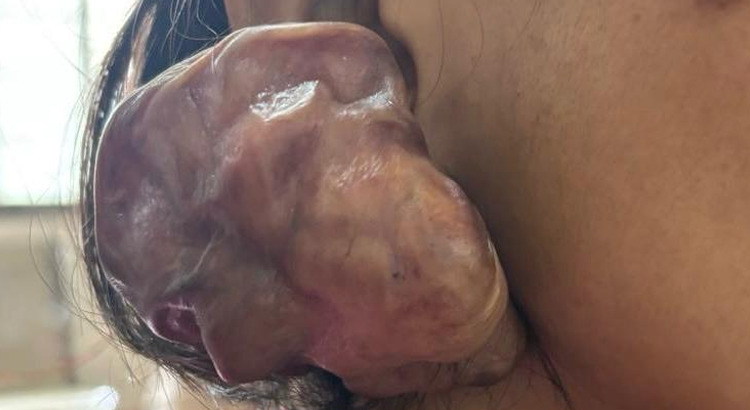 Ear Keloid Excision