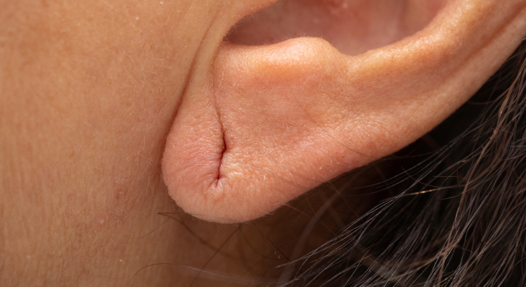Ear Lobe Repair