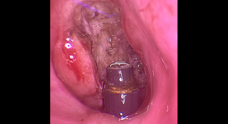 Endoscopic Coblation Assisted Adenotonsillectomy