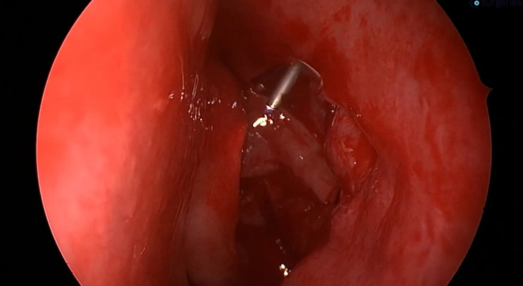 Endoscopic Dacryocystorhinostomy