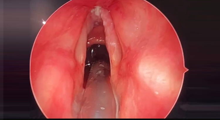 Endoscopic Laryngeal Surgery