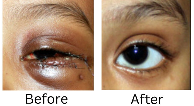 Endoscopic Orbital Surgery