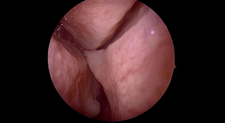 Endoscopic Septoplasty