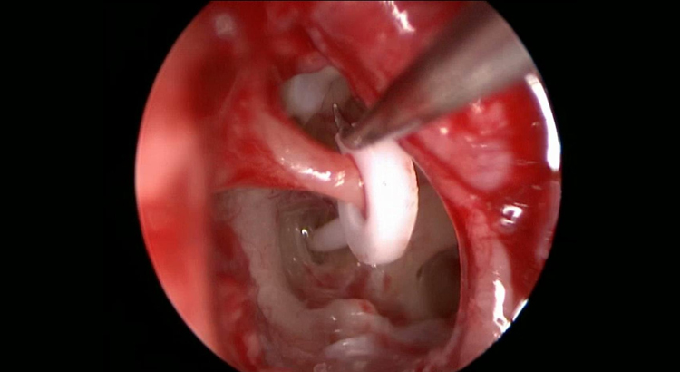Endoscopic Stapedotomy