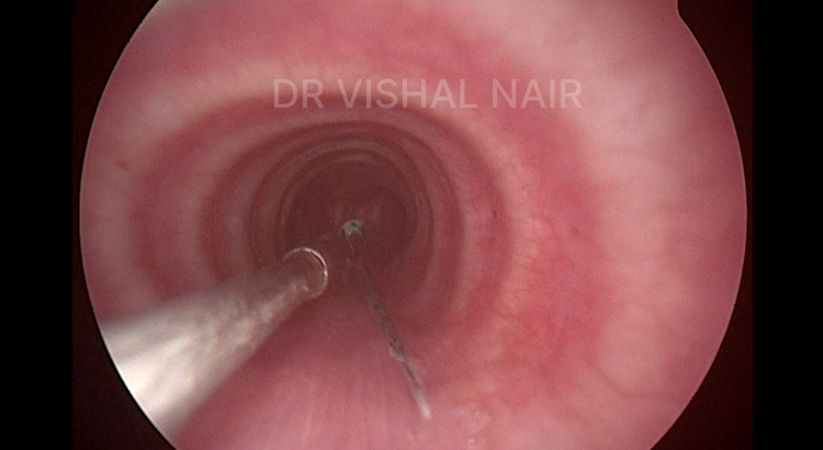 Foreign Body Removal from Oesophagus & Trachea