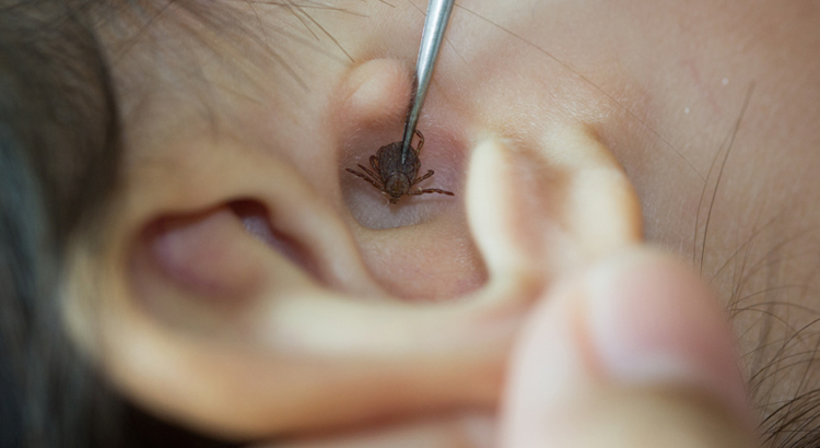 Foreign Body Removal from Ear