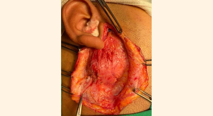 Parotid Surgery