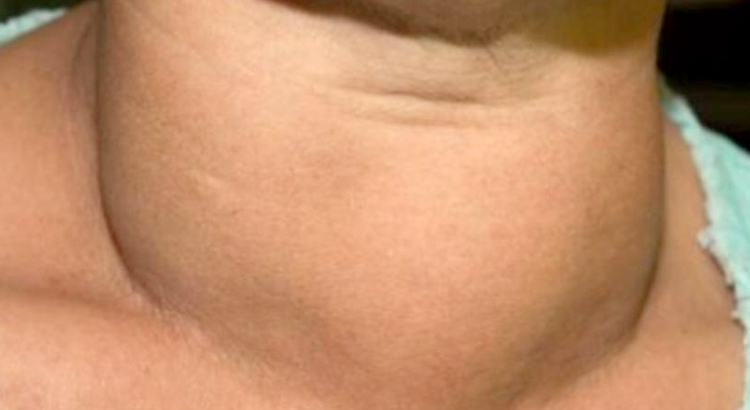 Thyroid Surgery