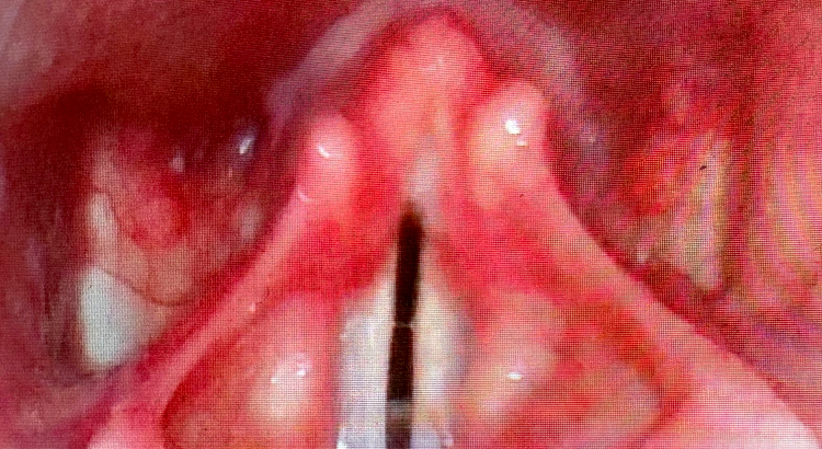 Videolaryngoscopic Evaluation of Voice